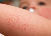Early Exposure to Antibiotics Augments Allergy, Eczema Risk Early Exposure to Antibiotics Augments Allergy, Eczema Risk