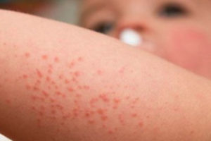 Early Exposure to Antibiotics Augments Allergy, Eczema Risk