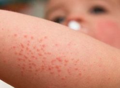 Early Exposure to Antibiotics Augments Allergy, Eczema Risk