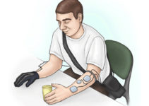 Stroke: Innovative electrical stimulation glove improves hand function Stroke: Innovative electrical stimulation glove improves hand function