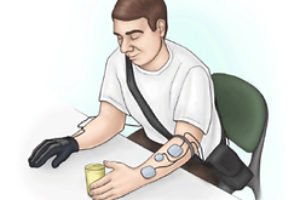 Stroke: Innovative electrical stimulation glove improves hand function