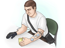 Stroke: Innovative electrical stimulation glove improves hand function