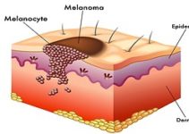 Tel Aviv University researchers unravel how melanoma spreads to distant organs Tel Aviv University researchers unravel how melanoma spreads to distant organs