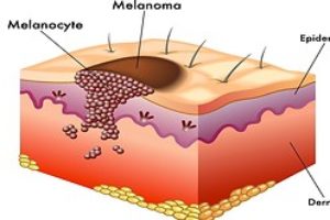 Tel Aviv University researchers unravel how melanoma spreads to distant organs