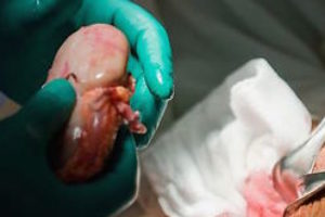 Progressive methods of organ transplantation