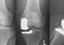 A new method of arthroplasty