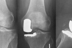 A new method of arthroplasty