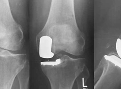 A new method of arthroplasty