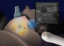 How to treat breast cancer in Israel How to treat breast cancer in Israel