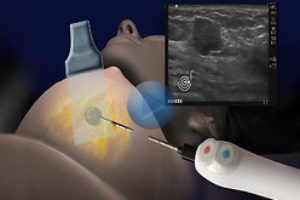 How to treat breast cancer in Israel