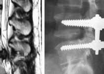 New discovery of spinal surgery New discovery of spinal surgery