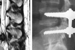 New discovery of spinal surgery