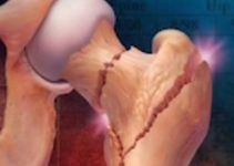 Israeli scientists developed a brand new method of treatment of osteoporosis Israeli scientists developed a brand new method of treatment of osteoporosis