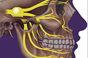 The predominant method of treatment of trigeminal neuralgia