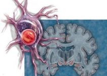 Neurodegerative diseases and their causes