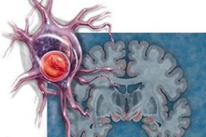 Neurodegerative diseases and their causes