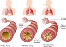 Israeli Pharma gets FDA Approval for New Antibody against Severe Asthma Israeli Pharma gets FDA Approval for New Antibody against Severe Asthma