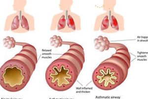 Israeli Pharma gets FDA Approval for New Antibody against Severe Asthma