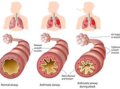 Israeli Pharma gets FDA Approval for New Antibody against Severe Asthma