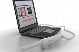 Early and Accurate detection of Cervical Cancer