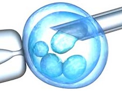 IVF (in vitro fertilization)